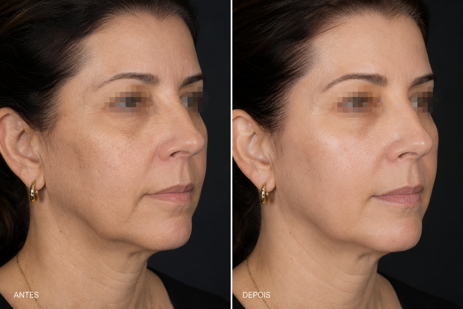 Antes e depois Skinbooster Porto Alegre