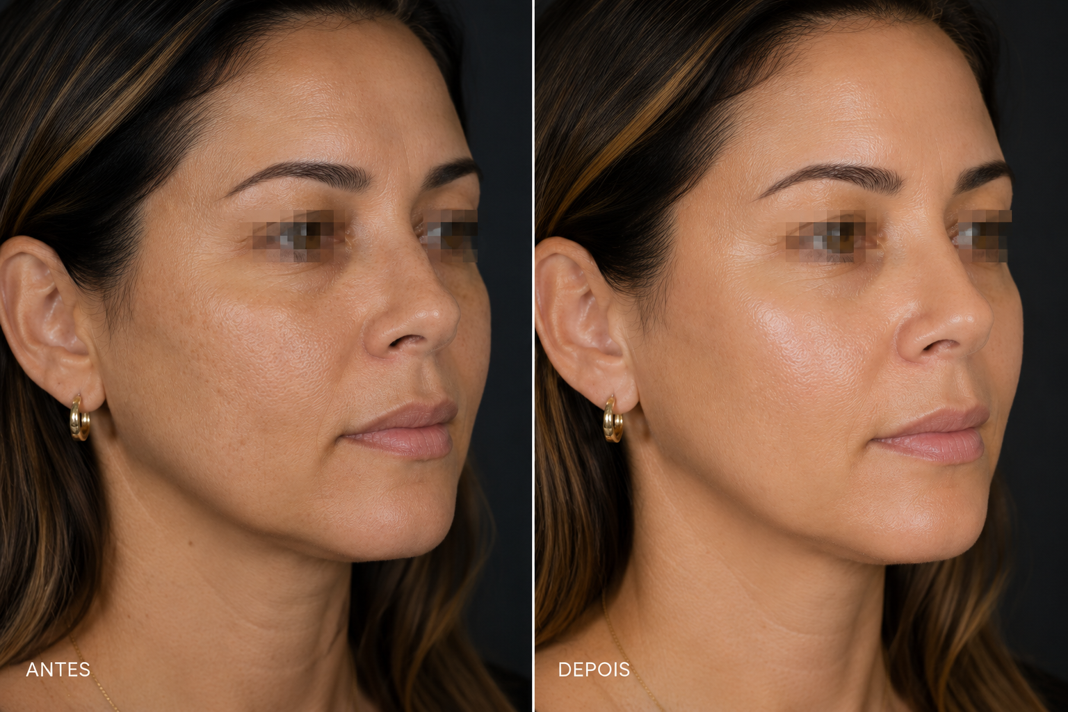 Antes e depois Skinbooster Porto Alegre